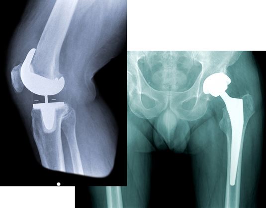 Orthopaedic implant grinding takes off as elective surgery resumes